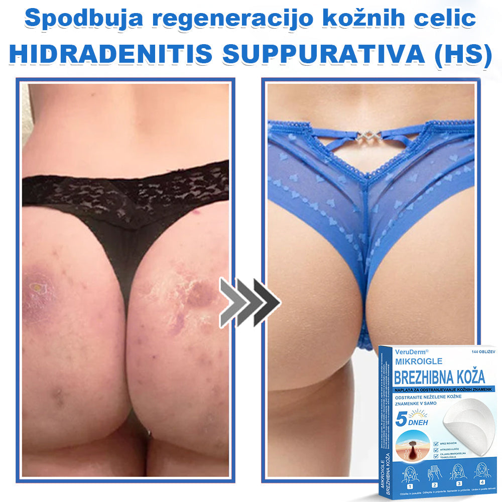 VeruDerm® 2 az 1-ben mikrotűs és hidrokolloid tapasz 🔥 | Kiemelkedő anyajegyek, pattanások, lapos szemölcsök és bőrkinövések ápolására ✅ | Segít javítani a ráncok, hegek és bőrhibák megjelenését ✨ | Láthatatlan pattanástapasz arcra és testre | 144 db 🌸🍇