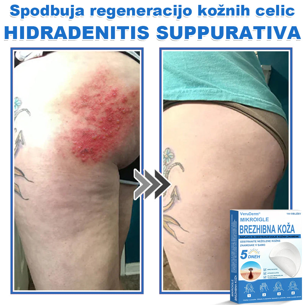 VeruDerm® 2 az 1-ben mikrotűs és hidrokolloid tapasz 🔥 | Kiemelkedő anyajegyek, pattanások, lapos szemölcsök és bőrkinövések ápolására ✅ | Segít javítani a ráncok, hegek és bőrhibák megjelenését ✨ | Láthatatlan pattanástapasz arcra és testre | 144 db 🌸🍇