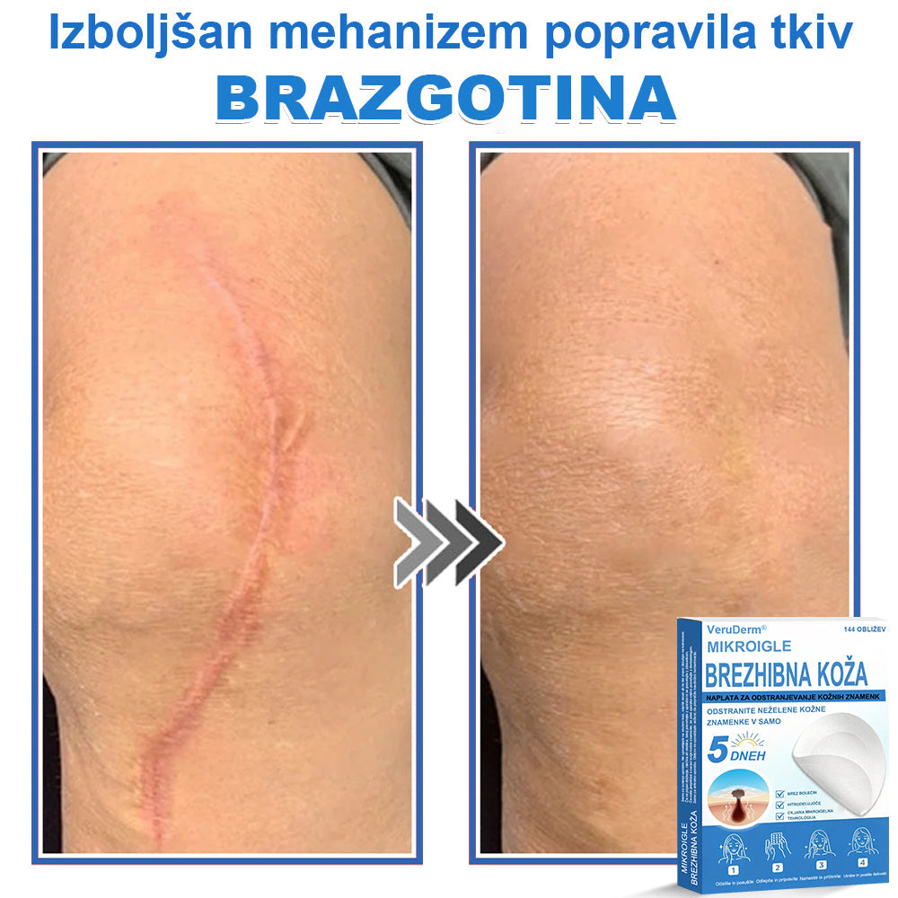 VeruDerm® 2 az 1-ben mikrotűs és hidrokolloid tapasz 🔥 | Kiemelkedő anyajegyek, pattanások, lapos szemölcsök és bőrkinövések ápolására ✅ | Segít javítani a ráncok, hegek és bőrhibák megjelenését ✨ | Láthatatlan pattanástapasz arcra és testre | 144 db 🌸🍇