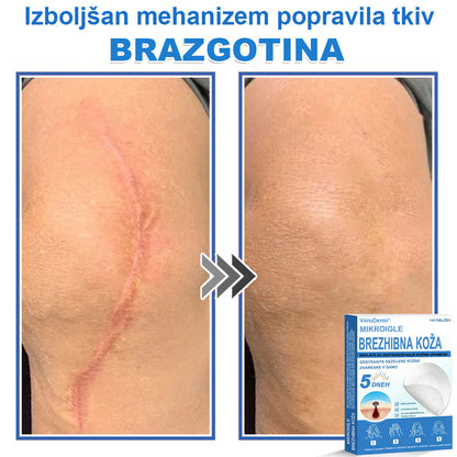 VeruDerm® 2 az 1-ben mikrotűs és hidrokolloid tapasz 🔥 | Kiemelkedő anyajegyek, pattanások, lapos szemölcsök és bőrkinövések ápolására ✅ | Segít javítani a ráncok, hegek és bőrhibák megjelenését ✨ | Láthatatlan pattanástapasz arcra és testre | 144 db 🌸🍇