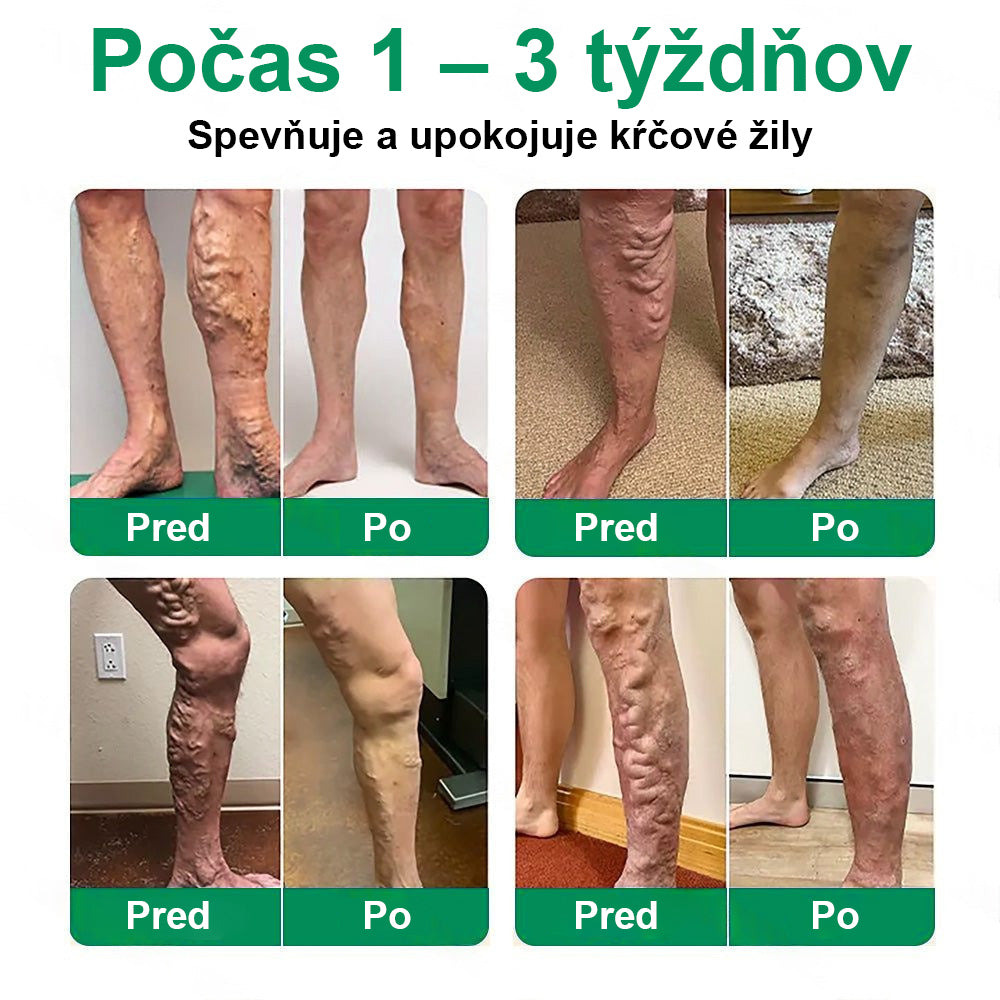 Twisma® VeinTarget – pokročilá mikro náplasť na kŕčové žily🩸 🔥 96 % klinicky preukázaná účinnosť ⚡ Viditeľné výsledky už za 7–14 dní 🌿 Jemná podporná starostlivosť pre ľahšie a uvoľnenejšie nohy 🦵💪