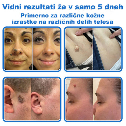 VeruDerm® 2 az 1-ben mikrotűs és hidrokolloid tapasz 🔥 | Kiemelkedő anyajegyek, pattanások, lapos szemölcsök és bőrkinövések ápolására ✅ | Segít javítani a ráncok, hegek és bőrhibák megjelenését ✨ | Láthatatlan pattanástapasz arcra és testre | 144 db 🌸🍇
