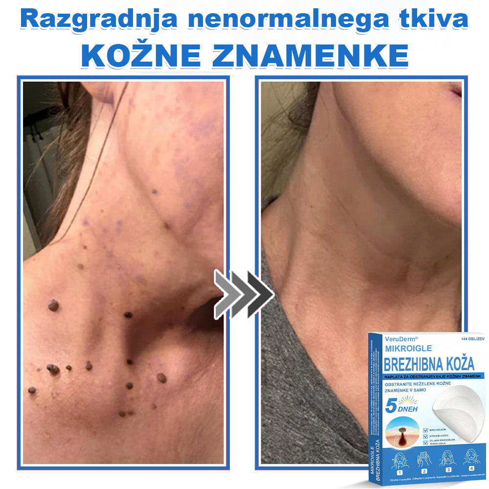 VeruDerm® 2 az 1-ben mikrotűs és hidrokolloid tapasz 🔥 | Kiemelkedő anyajegyek, pattanások, lapos szemölcsök és bőrkinövések ápolására ✅ | Segít javítani a ráncok, hegek és bőrhibák megjelenését ✨ | Láthatatlan pattanástapasz arcra és testre | 144 db 🌸🍇