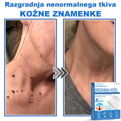VeruDerm® 2 az 1-ben mikrotűs és hidrokolloid tapasz 🔥 | Kiemelkedő anyajegyek, pattanások, lapos szemölcsök és bőrkinövések ápolására ✅ | Segít javítani a ráncok, hegek és bőrhibák megjelenését ✨ | Láthatatlan pattanástapasz arcra és testre | 144 db 🌸🍇