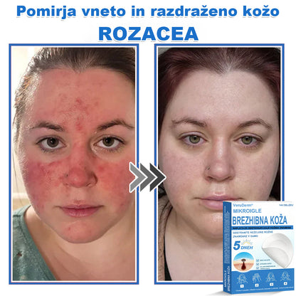 VeruDerm® 2 az 1-ben mikrotűs és hidrokolloid tapasz 🔥 | Kiemelkedő anyajegyek, pattanások, lapos szemölcsök és bőrkinövések ápolására ✅ | Segít javítani a ráncok, hegek és bőrhibák megjelenését ✨ | Láthatatlan pattanástapasz arcra és testre | 144 db 🌸🍇