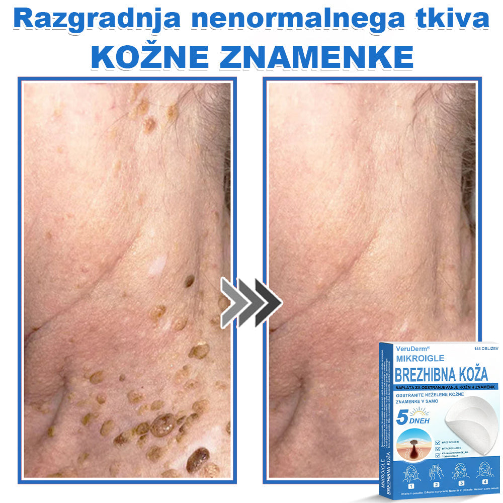VeruDerm® 2 az 1-ben mikrotűs és hidrokolloid tapasz 🔥 | Kiemelkedő anyajegyek, pattanások, lapos szemölcsök és bőrkinövések ápolására ✅ | Segít javítani a ráncok, hegek és bőrhibák megjelenését ✨ | Láthatatlan pattanástapasz arcra és testre | 144 db 🌸🍇