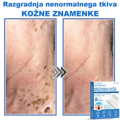 VeruDerm® 2 az 1-ben mikrotűs és hidrokolloid tapasz 🔥 | Kiemelkedő anyajegyek, pattanások, lapos szemölcsök és bőrkinövések ápolására ✅ | Segít javítani a ráncok, hegek és bőrhibák megjelenését ✨ | Láthatatlan pattanástapasz arcra és testre | 144 db 🌸🍇