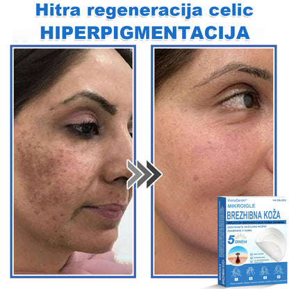 VeruDerm® 2 az 1-ben mikrotűs és hidrokolloid tapasz 🔥 | Kiemelkedő anyajegyek, pattanások, lapos szemölcsök és bőrkinövések ápolására ✅ | Segít javítani a ráncok, hegek és bőrhibák megjelenését ✨ | Láthatatlan pattanástapasz arcra és testre | 144 db 🌸🍇