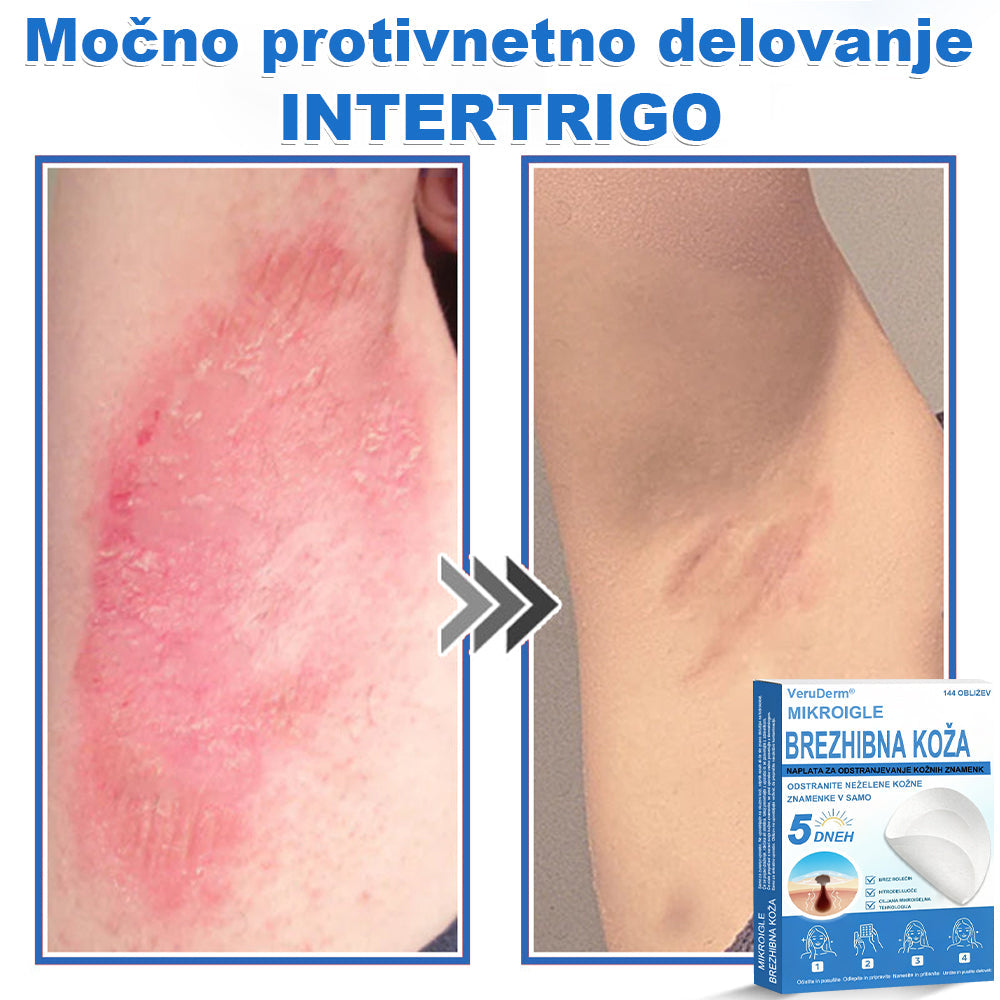 VeruDerm® 2 az 1-ben mikrotűs és hidrokolloid tapasz 🔥 | Kiemelkedő anyajegyek, pattanások, lapos szemölcsök és bőrkinövések ápolására ✅ | Segít javítani a ráncok, hegek és bőrhibák megjelenését ✨ | Láthatatlan pattanástapasz arcra és testre | 144 db 🌸🍇